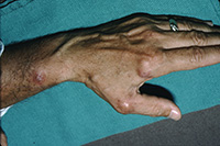 Mycobacterium marinum infection